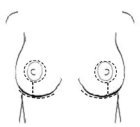 breast scarring