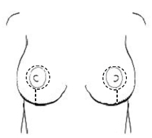 breast scars